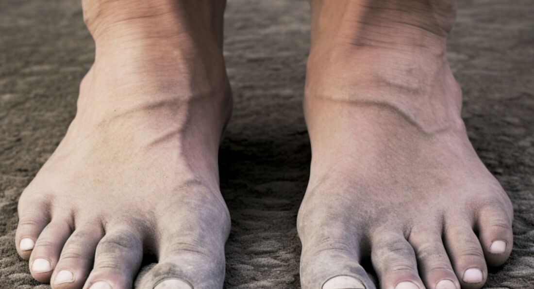 A Guide to Athlete's Foot: Causes, Preventions, and Remedies