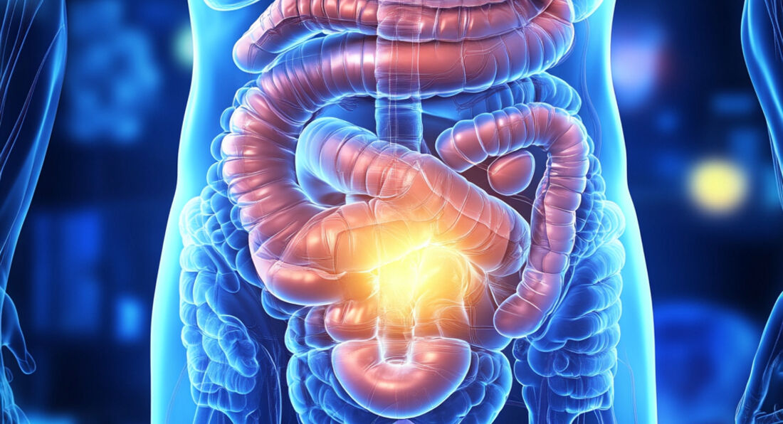 Can a leaky gut be the cause of Psoriasis?
