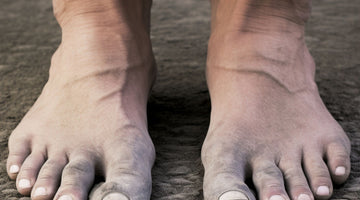 A Guide to Athlete's Foot: Causes, Preventions, and Remedies